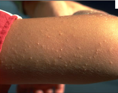 Tiny white bumps on forearm - Answers on HealthTap
